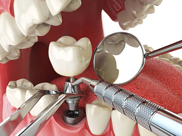 Best Emergency Root Canal Treatment in Palo Cedro, CA